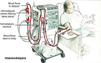 haemodialysis